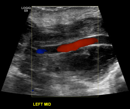 Post-operative duplex left popliteal artery aneurysm repair