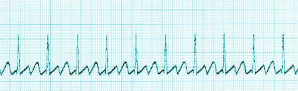 <p>Atrial Flutter, ECG</p>