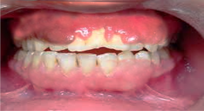 <p>Gingival Overgrowth. This image shows a patient with severe gingival overgrowth.</p>