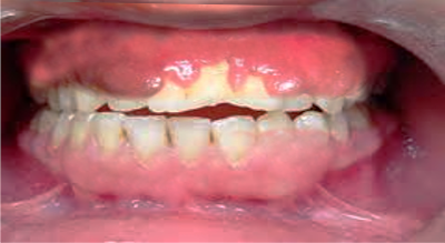 Gingival, [SATA]