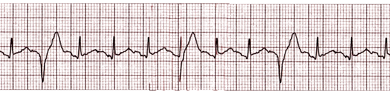 PVCs, Premature Ventricular Contractions, [SATA]