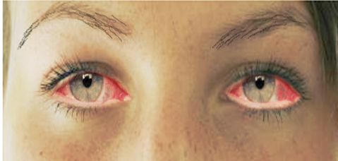 Viral conjunctivitis