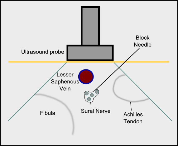 <p>Sural Nerve Block In-Plane Technique</p>