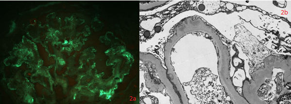 Renal biopsy HIVICK
IF and EM