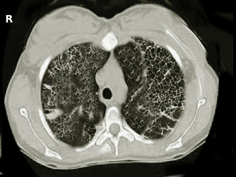 Lung fibrosis