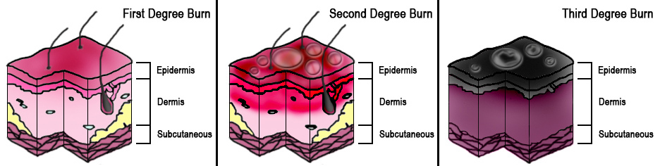 <p>Burn Degrees</p>