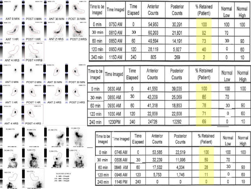 Gastric Emptying images/tables