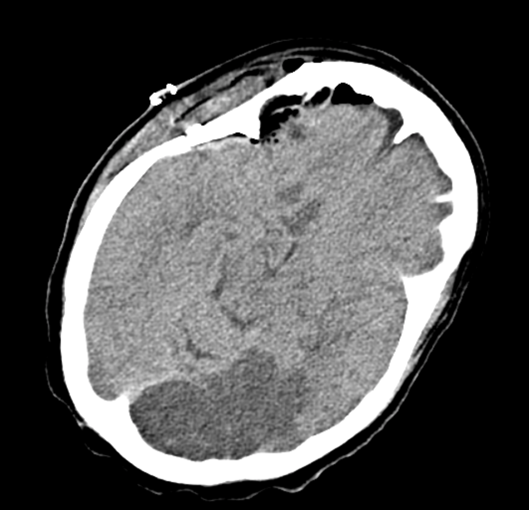 Figure 5 – An axial section on noncontrast CT head shows left PCA ischemic stroke and no hemorrhage.