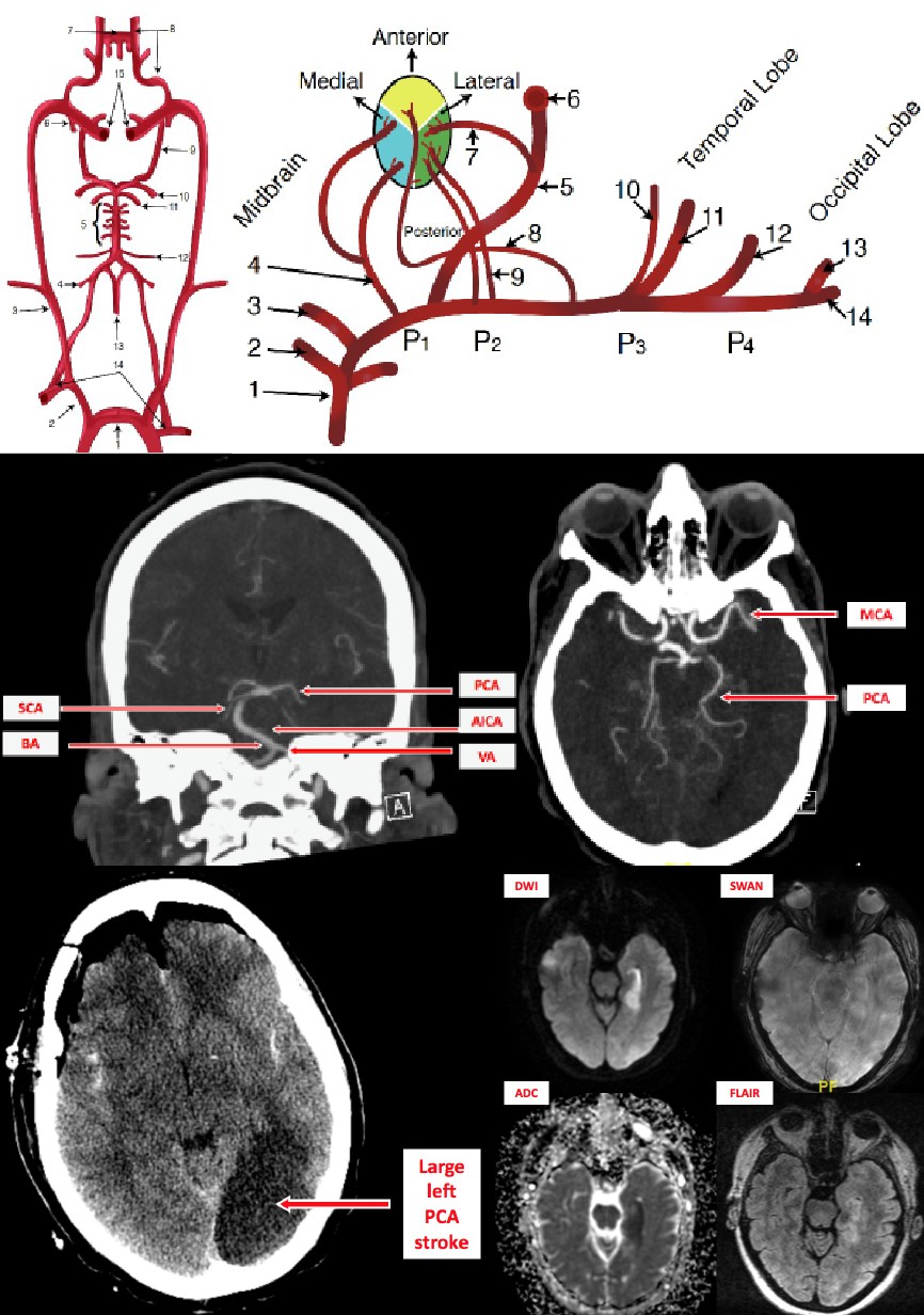 Stroke, Posterior Cerebral Artery