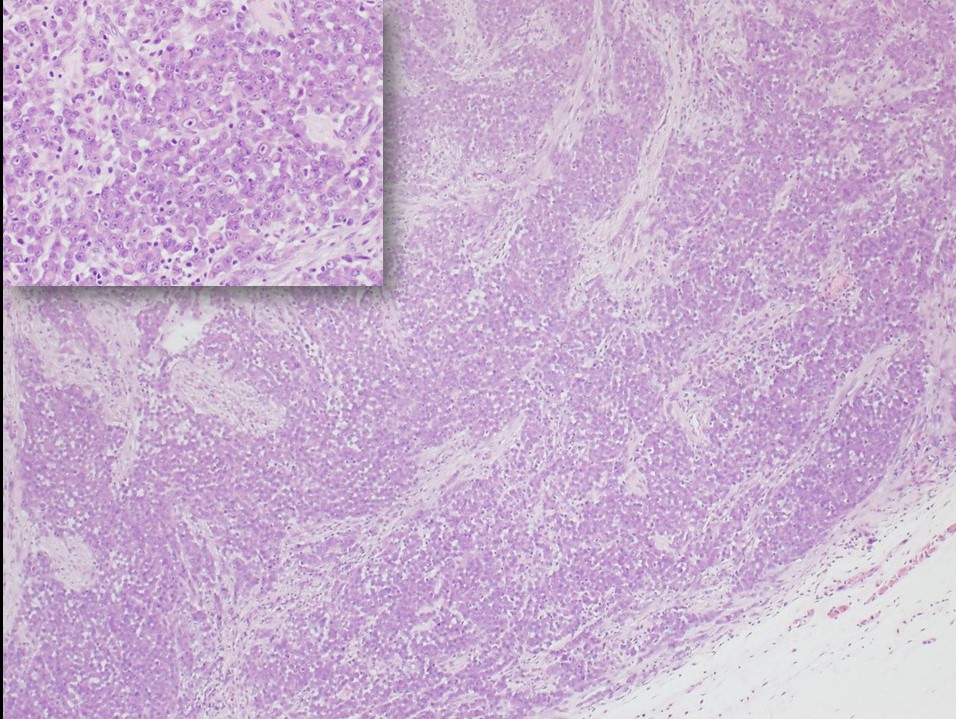 <p>Epithelioid Sarcoma, Proximal-Type