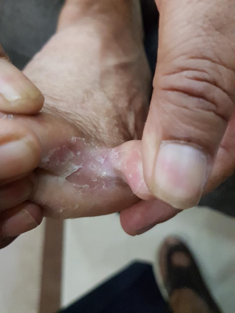 Tinea pedis