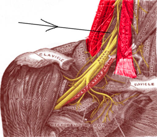 Interscalene block