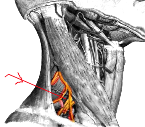 Interscalene block