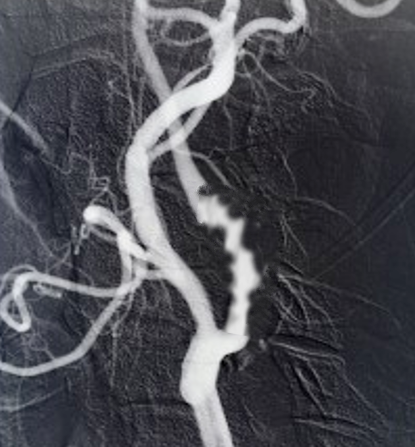 Fibromuscular dysplasia