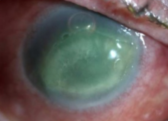 Stage II neurotrophic keratitis