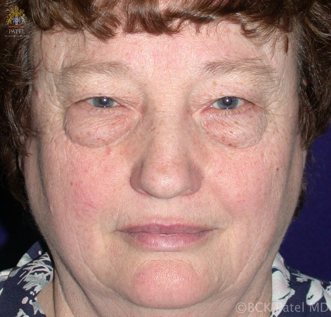 A 56-year-old female seeks lower eyelid blepharoplasty.