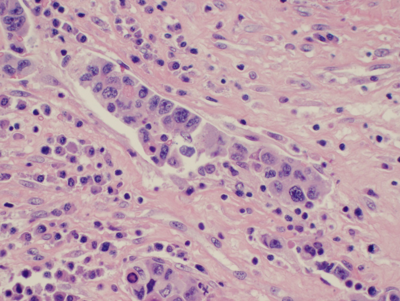 Sinusoidal involvement by anaplastic large cell lymphoma mimicking carcinoma.