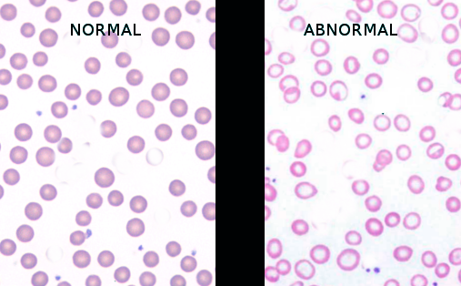 Iron deficiency anemia