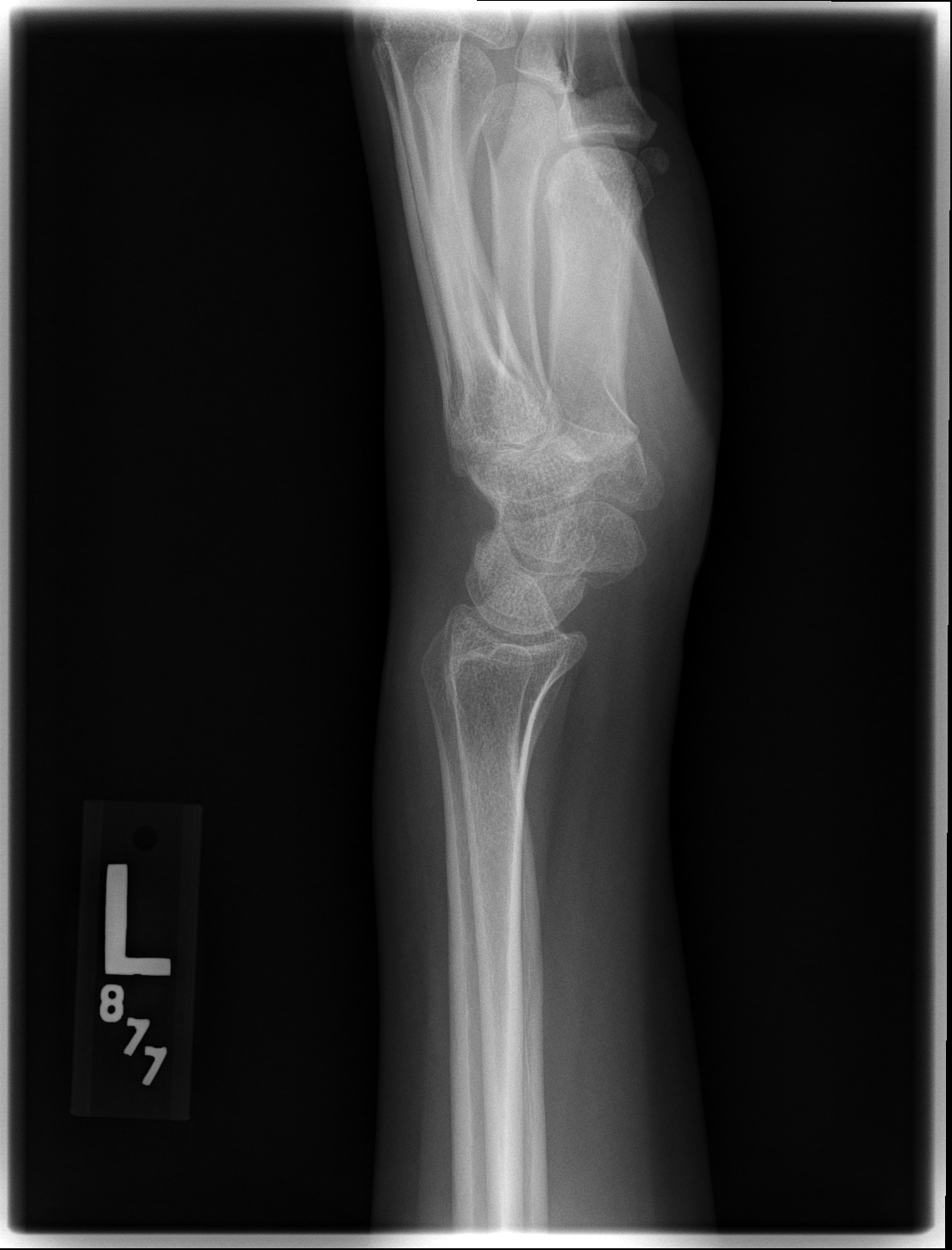 Volar Intercalated Segmental Instability; Lateral Wrist Radiograph