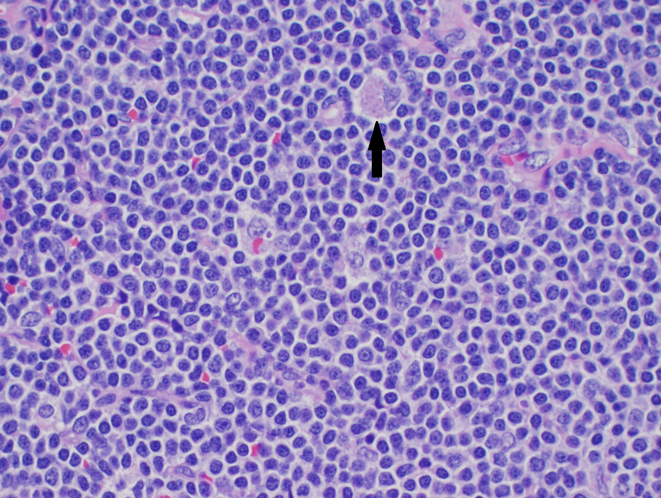 <p>Mantle Cell Lymphoma