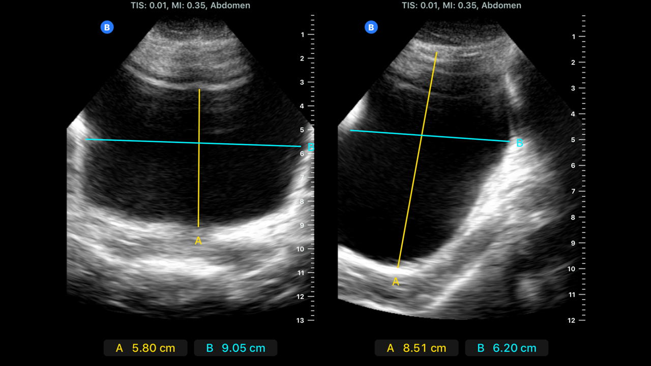 Bladder dimensions in sagittal and transverse views measured using ultrasound