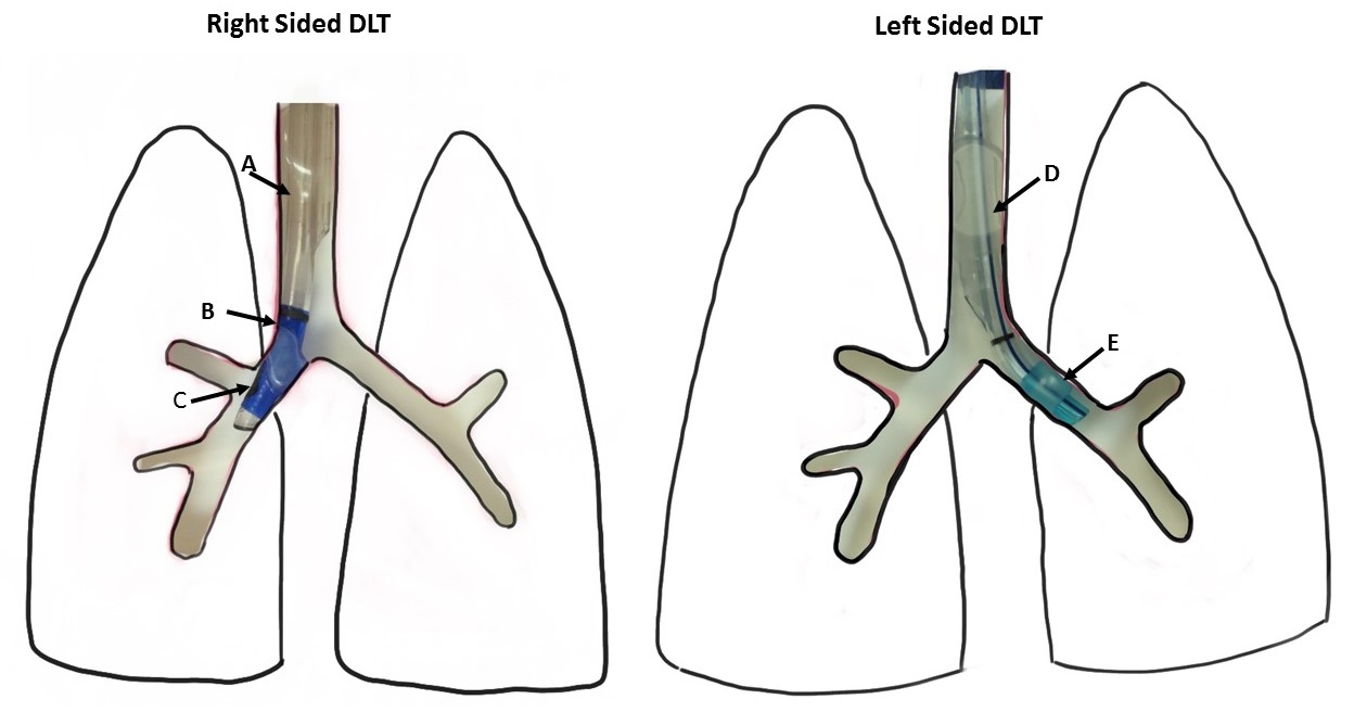 Optimal position of right and left sided double lumen tubes (DLTs)