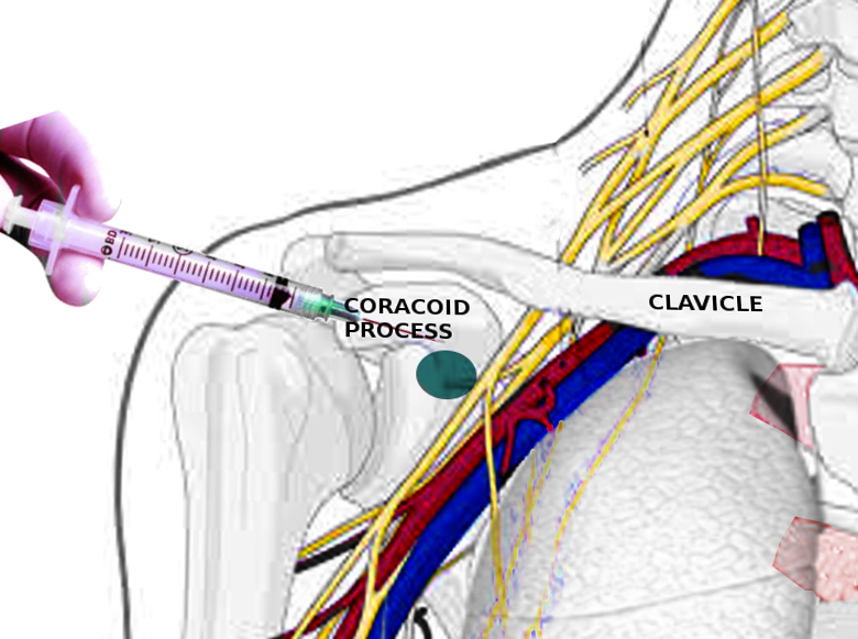 Infraclavicular block