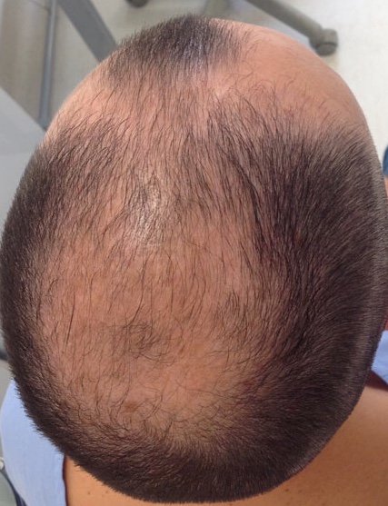 <p>Male-Pattern Androgenetic Alopecia. Hair loss from frontal, temporal, and central scalp areas.</p>