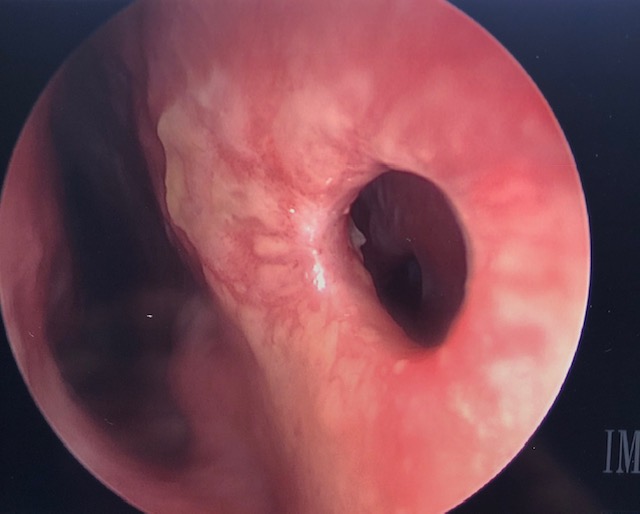 Nasal septal perforation