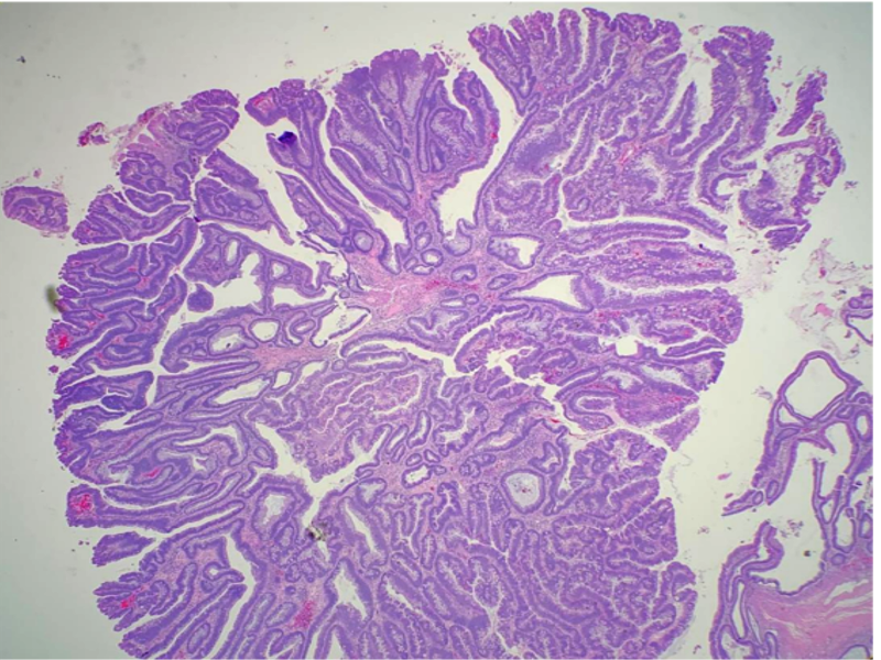 <p>Villous Adenoma</p>