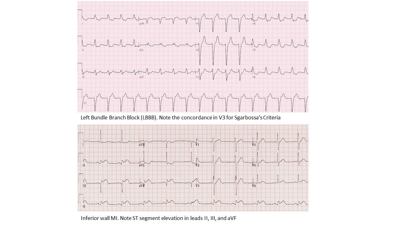 <p>ECG, Left Bundle Branch Block and Inferior Wall&nbsp;Myocardial Infarction</p>