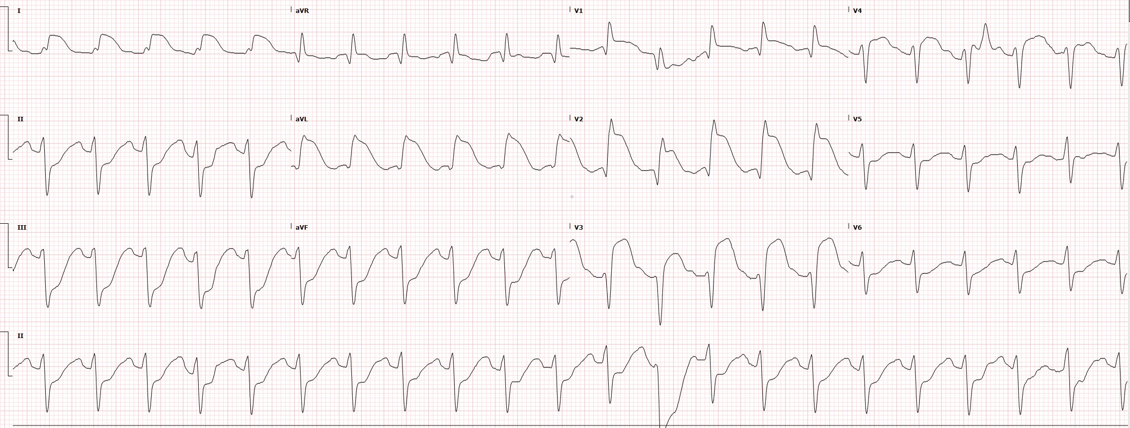 Proximal left anterior descending (LAD) occlusion resulting in anterior (V3, V4), septal (V1, V2), and high lateral (I, aVL) infarction