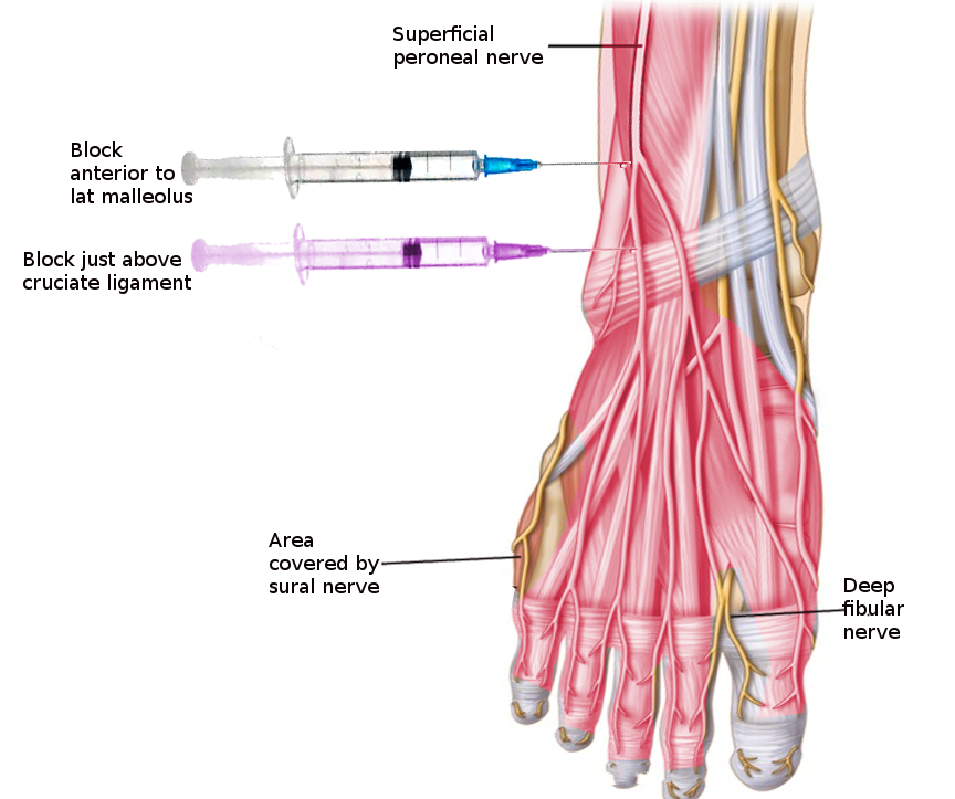 <p>Superficial Peroneal Nerve Block</p>
<p>&nbsp;</p>
<p>&nbsp;</p>