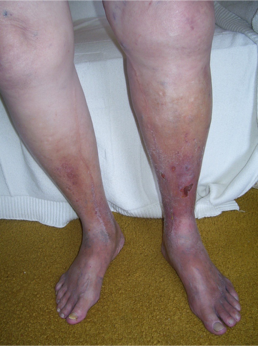 <p>Chronic Venous Insufficiency