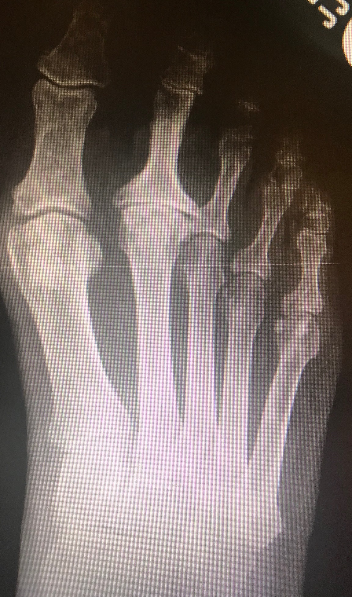 <p>Freiberg Dorsal-Plantar X-ray