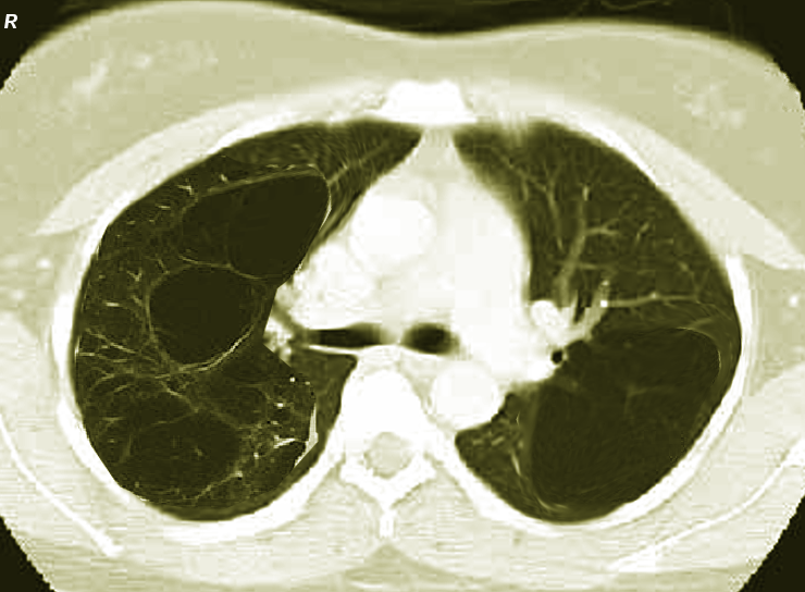 <p>Bilateral Bullous Emphysema, Computed Tomography. This computed tomography image shows bilateral bullous emphysema.</p>