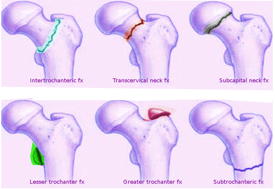 <p>Femoral Hip Fractures