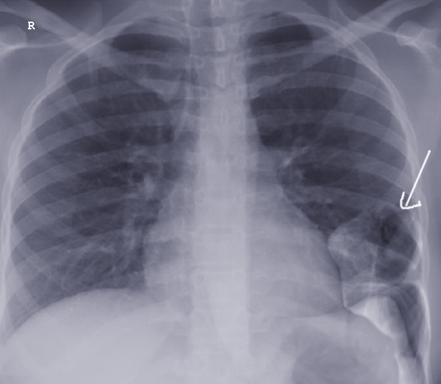 Acquired Diaphragmatic Hernia