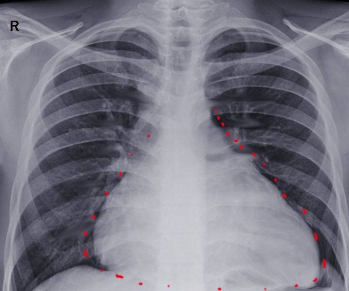 Uremic effusion