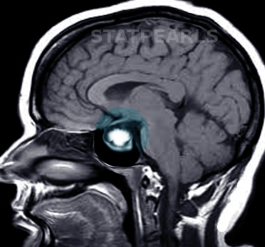 Prolactinoma MRI