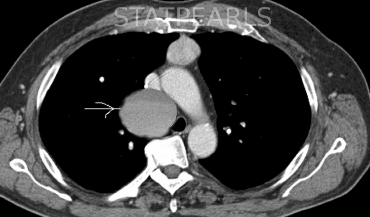 Bronchogenic cyst