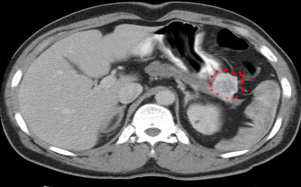 Gastrinoma on distal pancreas