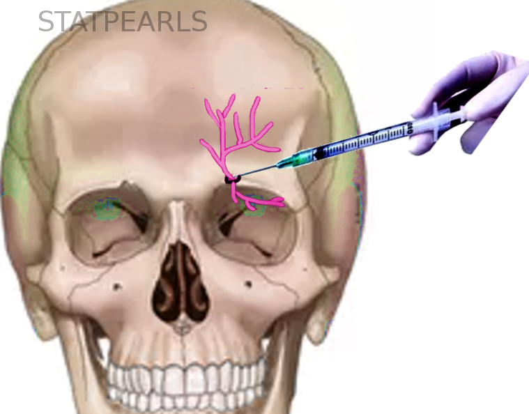 <p>Supraorbital Nerve Block</p>