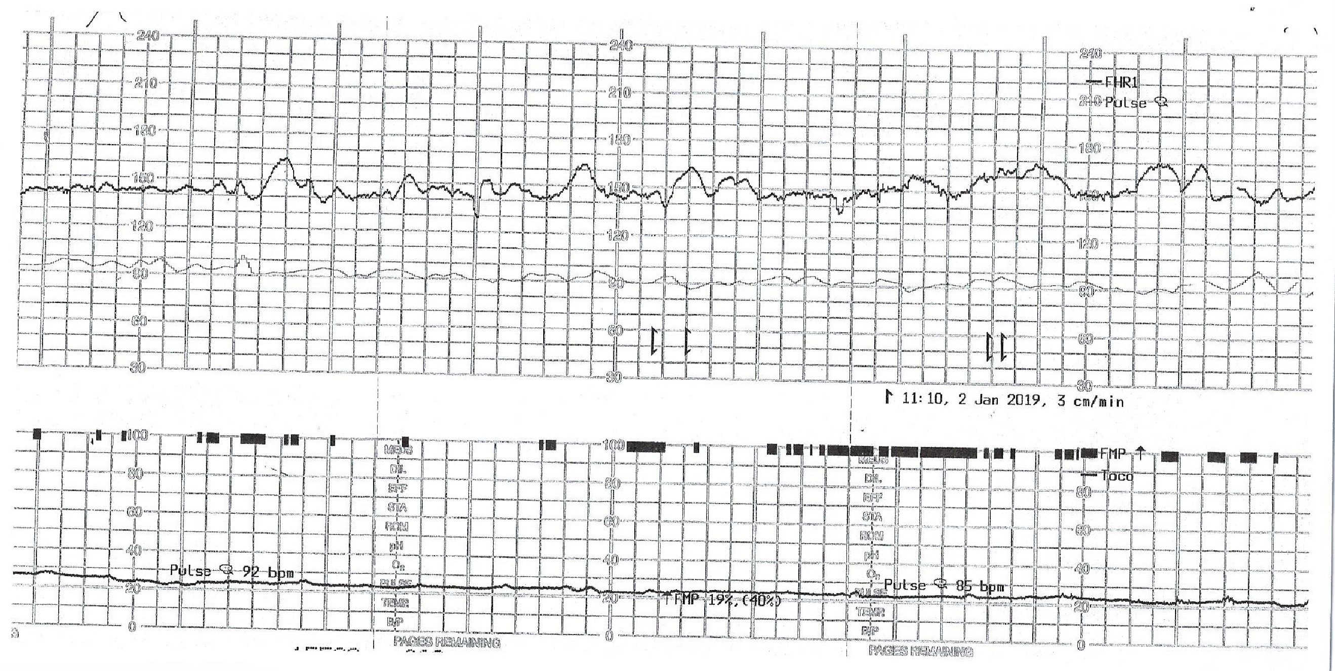 <p>Nonstress Test