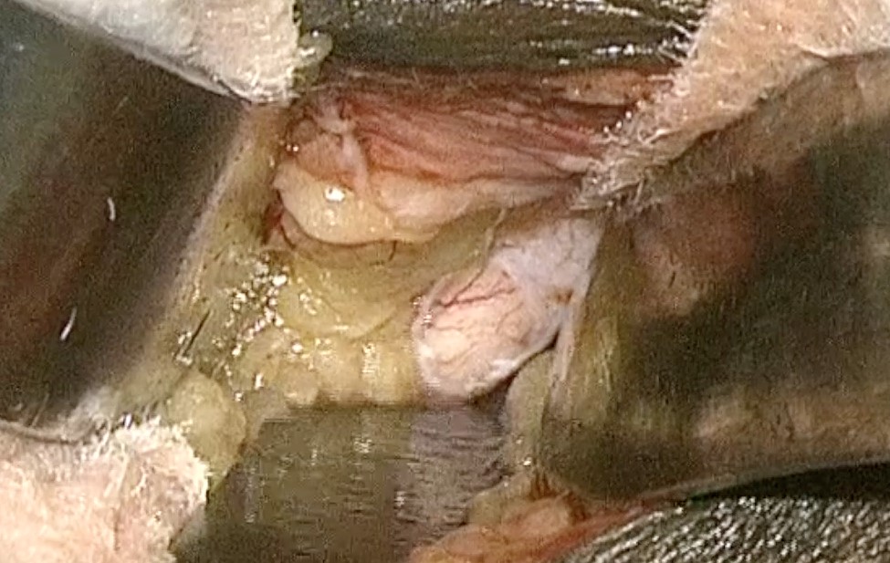 Image of optic nerve sheath durotomy during optic nerve sheath fenestration via lid crease approach.