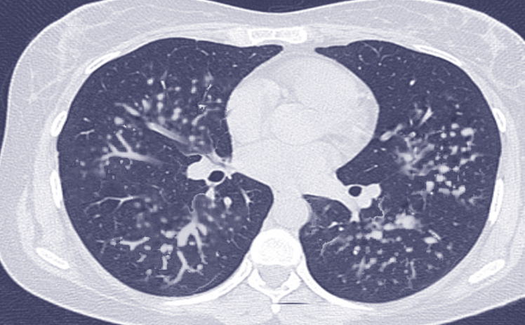 Silicosis, Computed Tomography