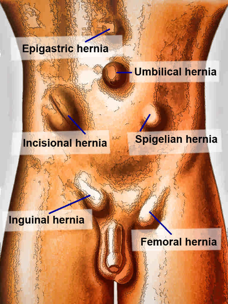 <p>Abdominal Hernias</p>