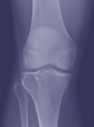 Chondroblastoma