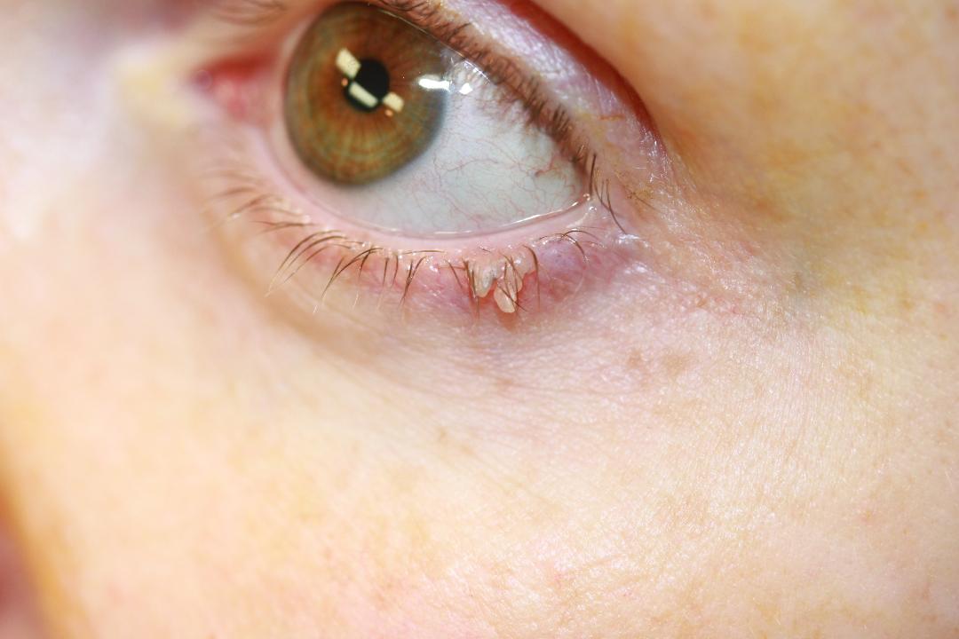 eyelid papilloma