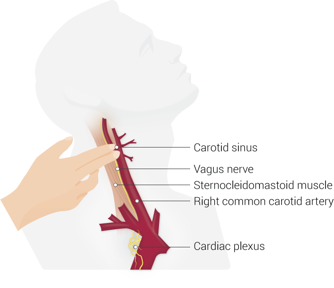 <p>Carotid Sinus Massage